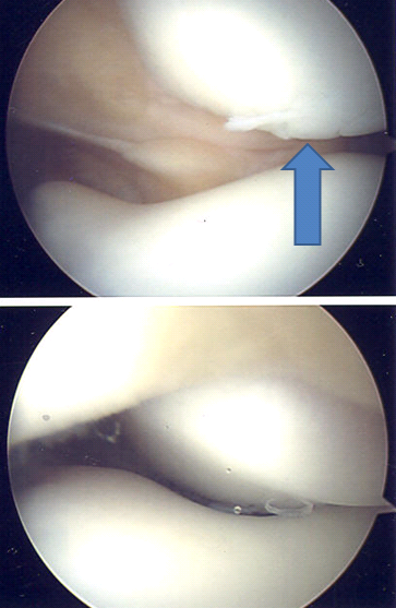 maligned lateral patella sos