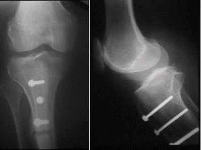 fulkerson osteotomy
