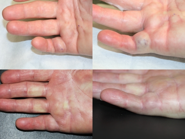dupuytrens contracture near utica ny image of hands with dupuytrens contracture bending fingers and lump on palm
