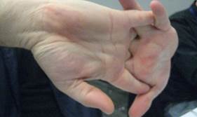 hands cracking knuckles causes Carpal Tunnel Syndrome read more for SOS near Syracuse NY