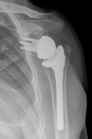 shoulder replacement surgery