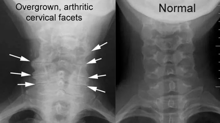 facet arthritis image of overgrown arthritic cervical facets compared to normal facet joints