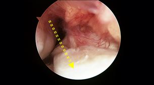 ACL Reconstruction: Graft Choices