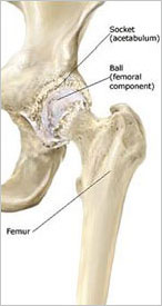 Hip Resurfacing Technique from SOS