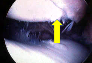 advanced chondromalacia affecting both patella