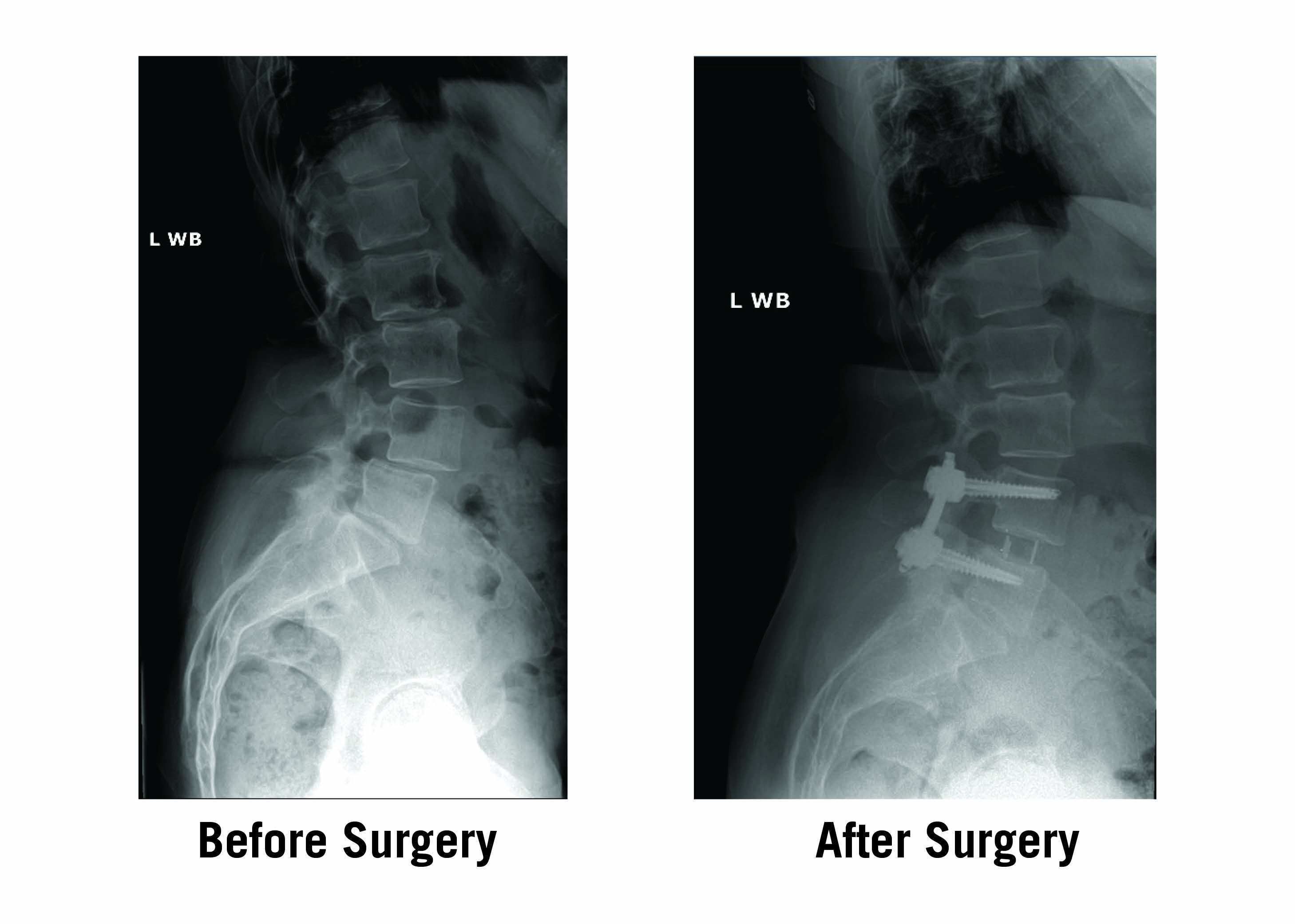 Lateral X-Ray View of Patient Spine Before and After PTP Procedure with Dr. Iorio