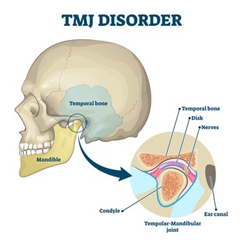TMJ Disorder and Description
