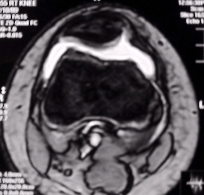 axial patella sos