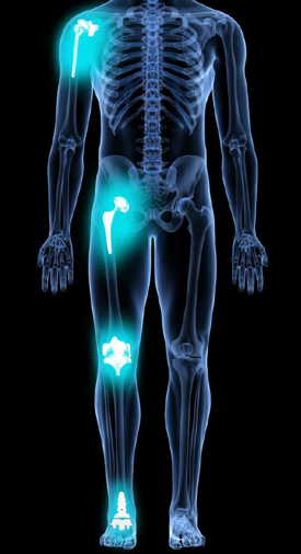 joint replacement x-ray image of shoulder knee hip and ankle