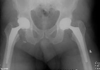 Hip Resurfacing X-Ray from SOS