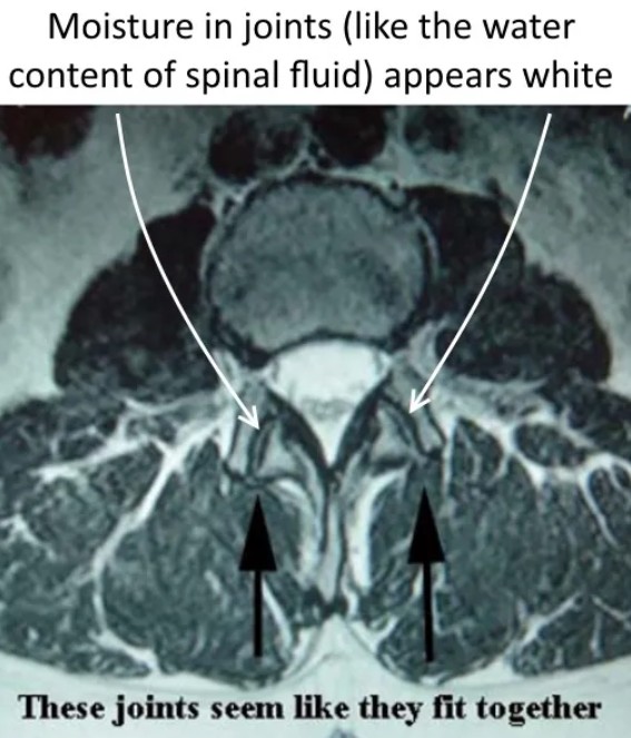 model of facet arthritis moisture in joints like the water content of spinal fluid appears white these joints seem like they fit together