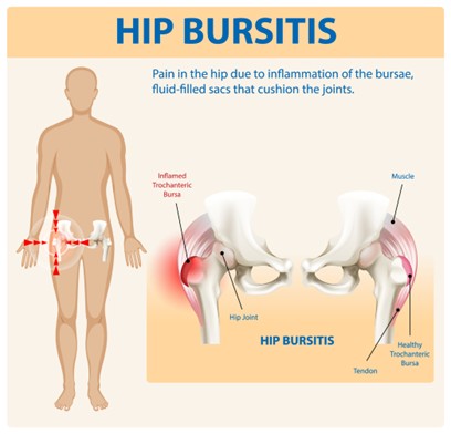 hip bursitis diagram pain in the hip due to inflammation of the bursae fluid filled sacs cushion joints inflammed trochanteric bursa muscle tendon healthy trochanteric bursa diagram
