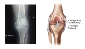 Knee Pain Osteoarthritic Knee from SOS