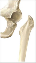 Conventional Hip Replacement from SOS