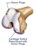 OSTEOCHONDRAL AUTOGRAFT example from syracuse orthopedic specialists
