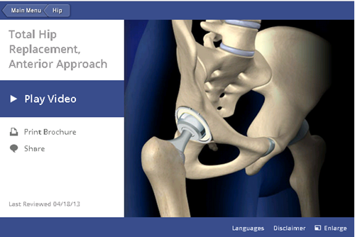 Total Hip Replacement, Anterior Approach