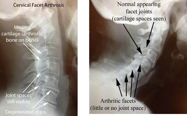 facet arthritis early cervical facet arthrosis image with labels for missing cartilage arthrosis bone on bone joint spaces still visible degenerated discs compared to normal appearing facet joints cartilage spaces seen arthritic facets little or no joint space