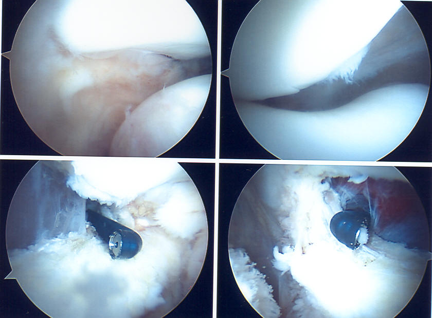 repair and reconstruct lateral release