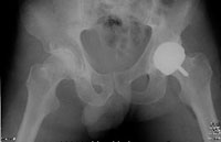 Hip Resurfacing X-Ray from SOS
