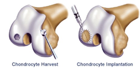 Diagram of an Autologous Cartilage Cell Implantation