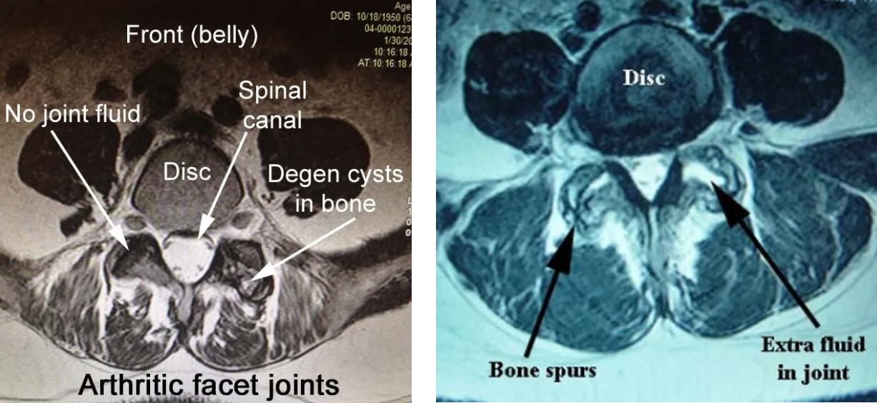 facet arthritis image of the arthritic facet joints with labels for no joint fluid spinal canal disc degen cysts in bone front belly compared to image with disc bone spurs and extra fluid in joint