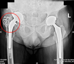 Hip Resurfacing X-Ray from SOS