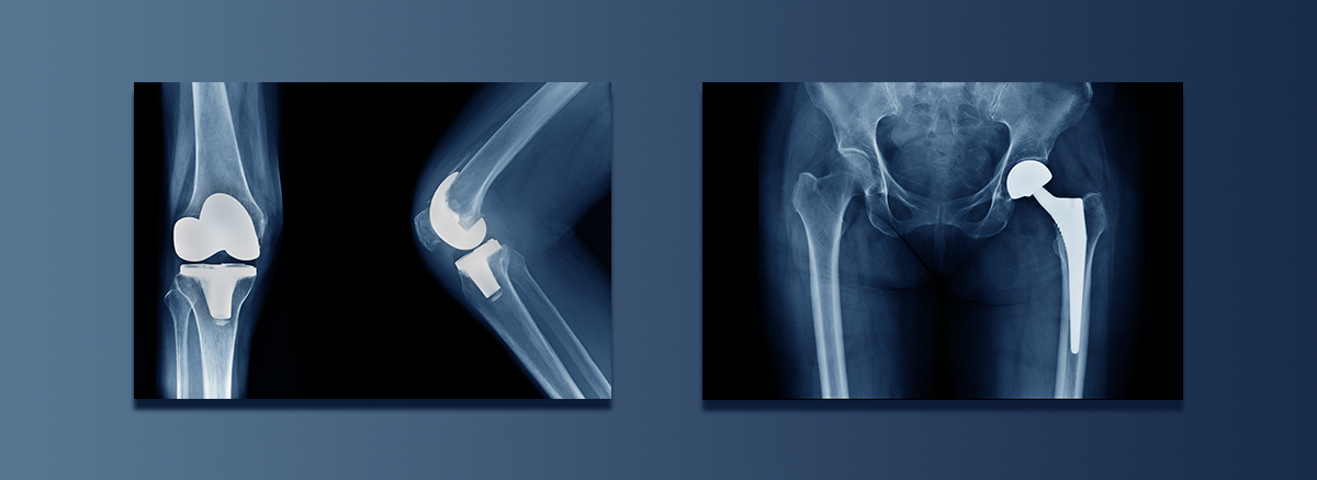 Joint Replacement Symposium 2023 from syracuse orthopedic specialists Joint Seminar