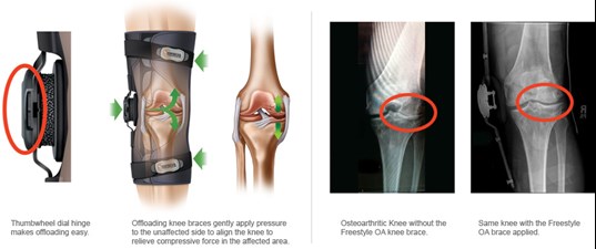 Knee Braces How Oa Braces Work from SOS