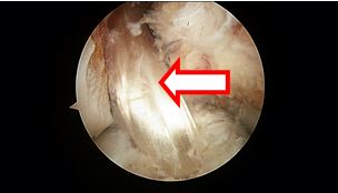 ACL Reconstruction: Graft Choices