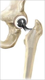 Conventional Hip Replacement from SOS