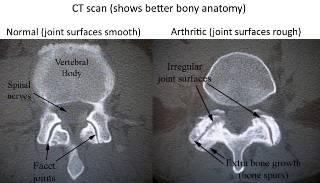 spine anatomy from sos syracuse orthopedic specialists model of the ct scan arthritic facet joints
