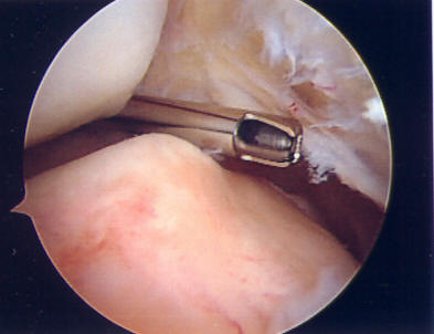 synovial plica arthroscopic