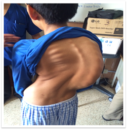 congenital scoliosis